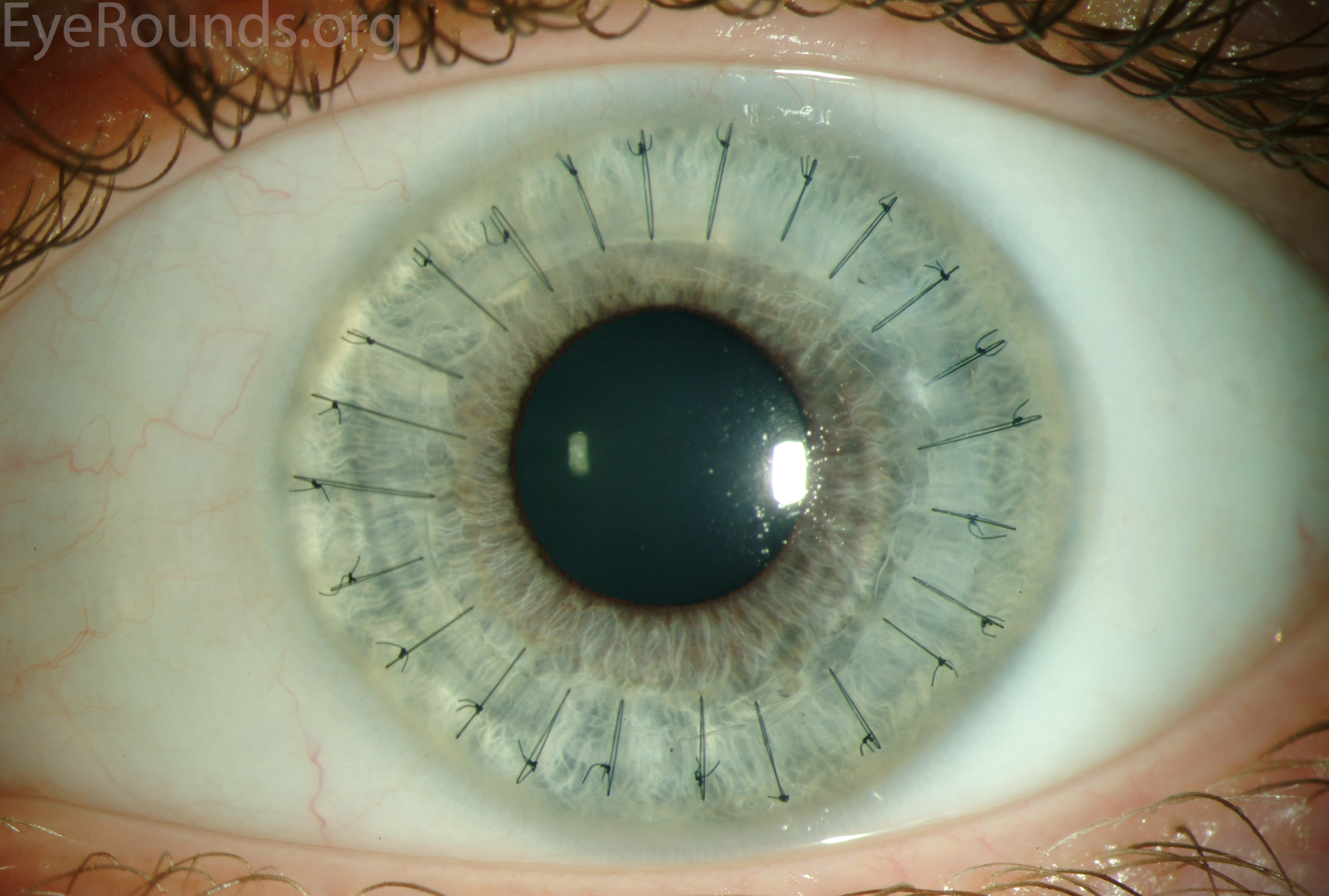 Донор зрение. Кератоконус имплантация роговицы. Сквозная кератопластика роговицы🙈🙈🙈. Кератоконус роговицы глаз. Склеральные линзы кератоконус.