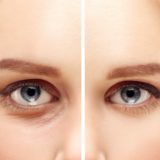 Eyelid surgery عمليات تجميل العيون