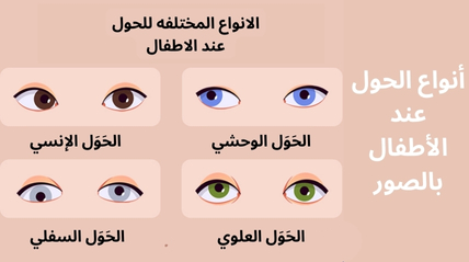 أنواع الحول عند الأطفال بالصور الحَوَل الإنسي (Esotropia) الحَوَل الوحشي (Exotropia) الحَوَل العلوي (Hypertropia) الحَوَل السفلي (Hypotropia)