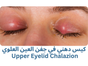 كيس دهني في جفن العين العلوي - Upper Eyelid Chalazion