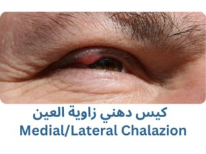 كيس دهني زاوية العين (Medial/Lateral Chalazion)