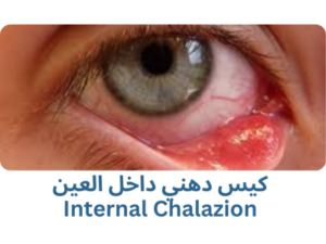 كيس دهني داخل العين Internal Chalazion