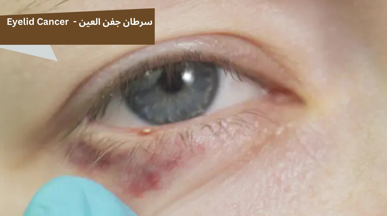 صورة توضح أعراض سرطان جفن العين مثل الكتلة أو التورم في الجفن