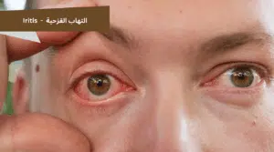 صورة توضح التهاب القزحية وأعراضه، وتتناول ما هو التهاب القزحية، أسباب التهاب القزحية، أعراض وعلامات التهاب القزحية، بالإضافة إلى عوامل خطر الإصابة بالتهاب القزحية، وطرق تشخيصه، مع ذكر عوامل تزيد فرصة التهاب القزحية. كما تعرض مضاعفات التهاب القزحية مثل الساد أو الماء الأبيض (Cataract) والزرق (Glaucoma)، وتشير إلى طرق علاج التهاب القزحية في المنزل، وأسباب تكراره، ومدة علاج التهاب القزحية، والإجابة عن سؤال هل التهاب القزحية خطير، مع التطرق إلى قرحة القرنية (التهاب القرنية) كمشكلة عينية مصاحبة.