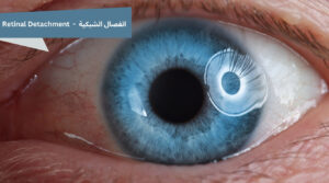 انفصال الشبكية بالانجليزيه : Retinal Detachment حالة طبية خطيرة قد تهدد النظر. تعرّف على الأسباب، طرق التشخيص، خيارات العلاج، ونسب تحسن الرؤية بعد التدخل الطبي. Retinal Detachment