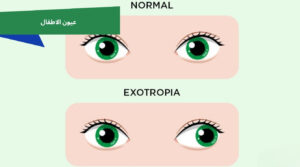 أسباب وأعراض الحول الوحشي | حول وحشي عند الأطفال والكبار وطرق العلاج