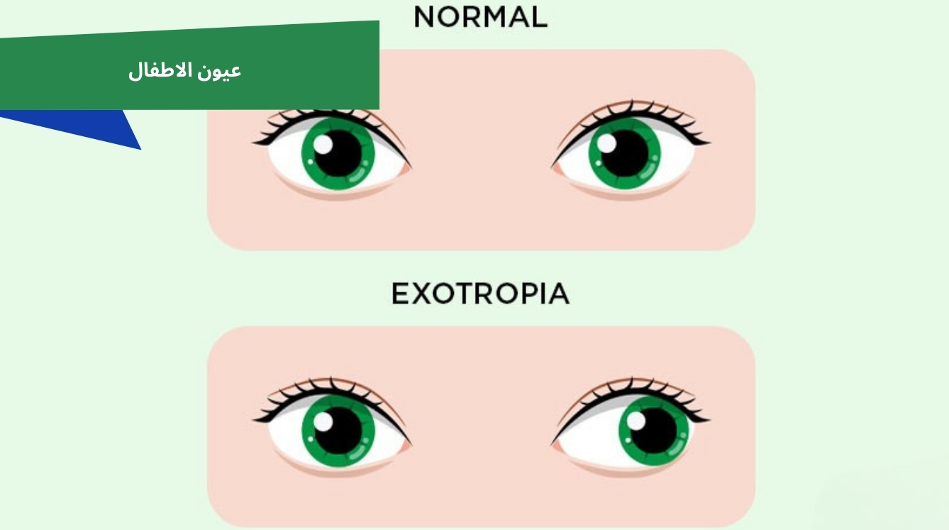 أسباب وأعراض الحول الوحشي | حول وحشي عند الأطفال والكبار وطرق العلاج