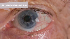 سرطان العين من الأورام النادرة التي تتطلب تشخيصًا مبكرًا. تعرف على الأعراض والأنواع وطرق العلاج وفق المعايير الطبية العالمية.